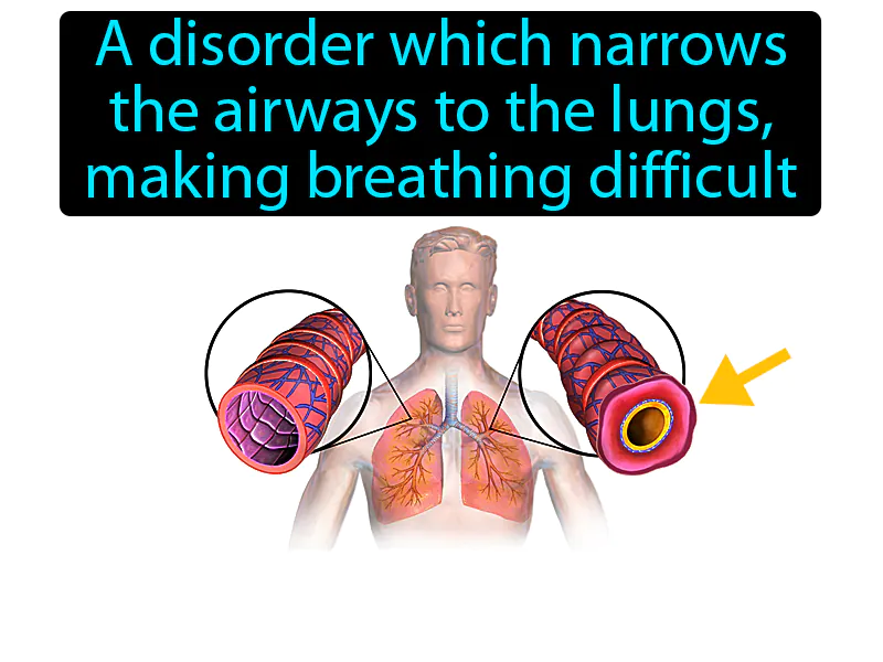 Asthma Definition Asthma Definition